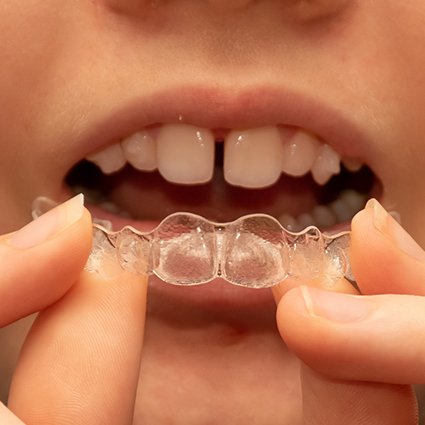 Closeup of clear aligners being placed over gapped teeth