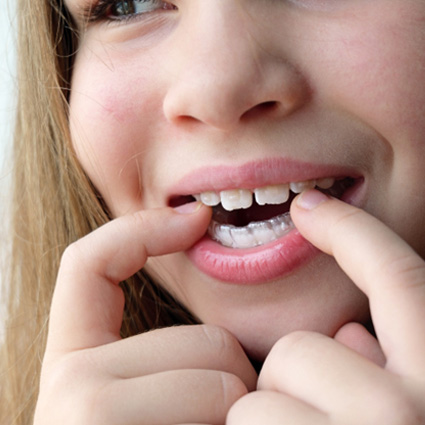 Teen in Naperville putting on aligners
