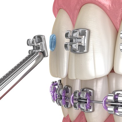A CGI of braces being applied to teeth