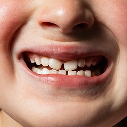 A child with bite misalignment