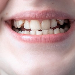 A child with crooked teeth