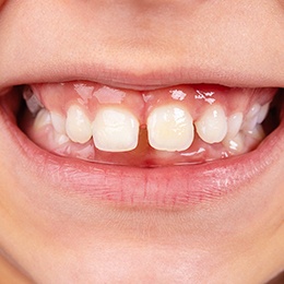 A child with gapped teeth