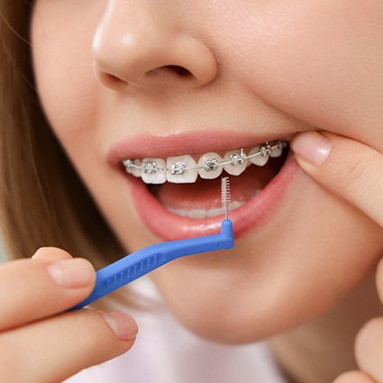 A teen using an interproximal brush on her braces