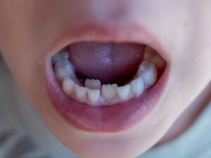 Photo of shark teeth in child’s mouth
